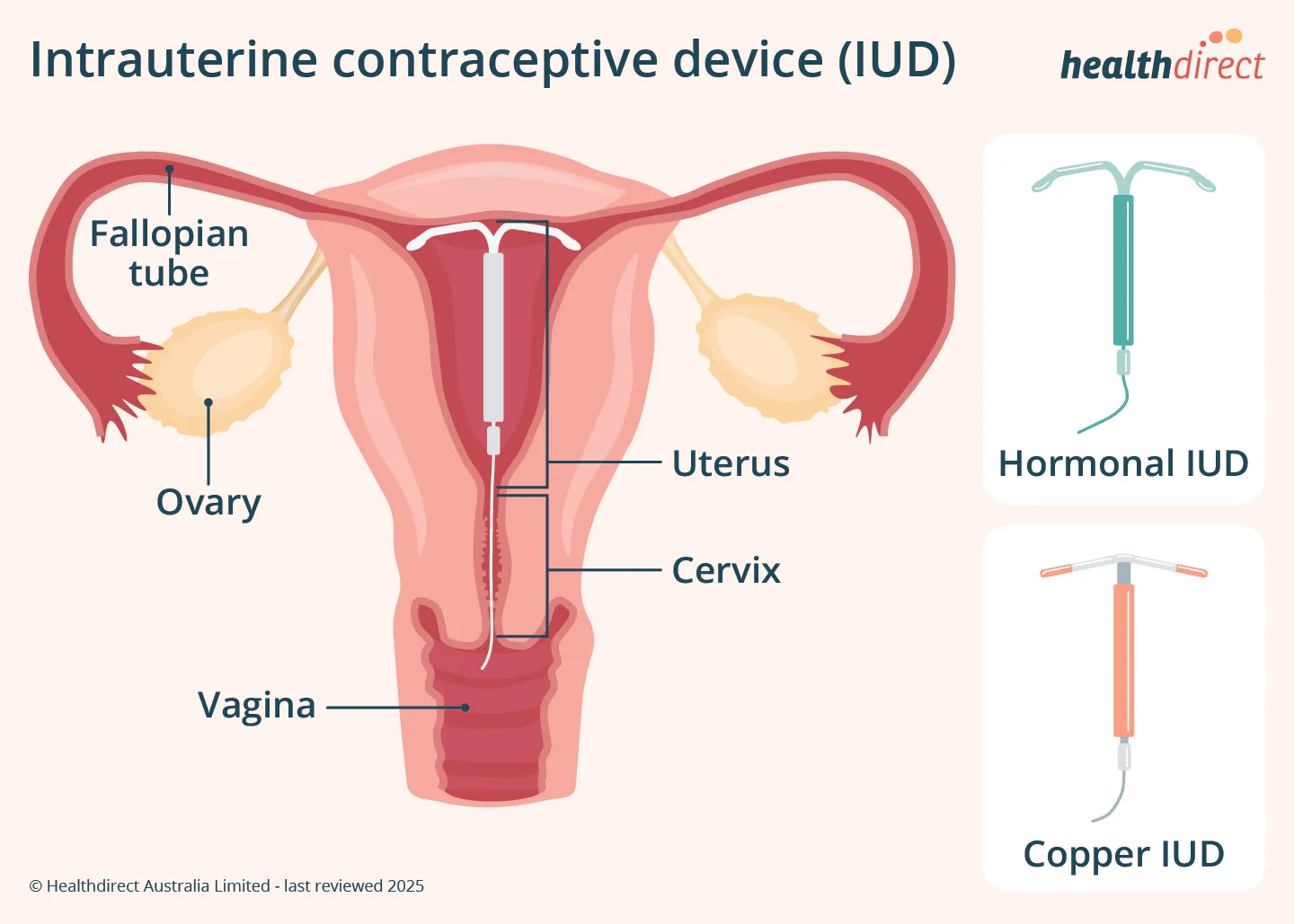 Image illustrating IUD placement