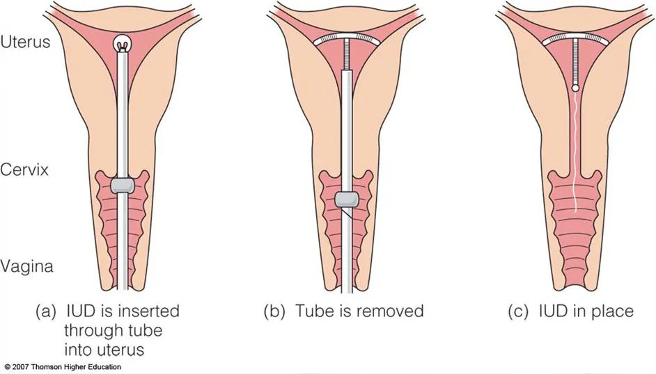 Image illustrating IUD insertion steps