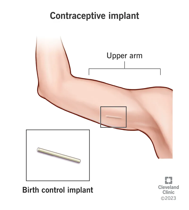 image illustrating contraceptive implant placement