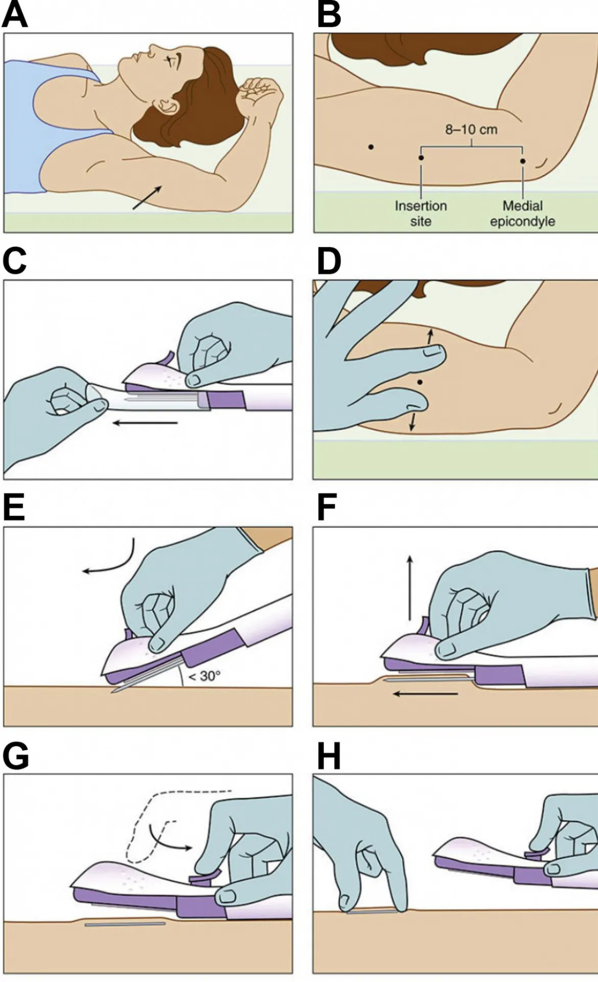 Implant insertion steps